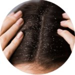 Dandruff
