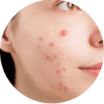 Acne Prone Skin